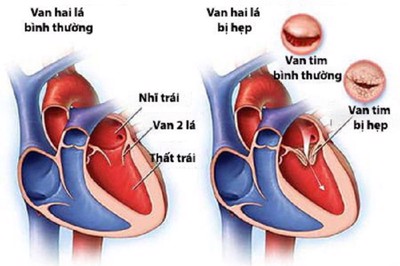 Hẹp van tim: 6 điều cần biết để tránh biến chứng nguy hiểm